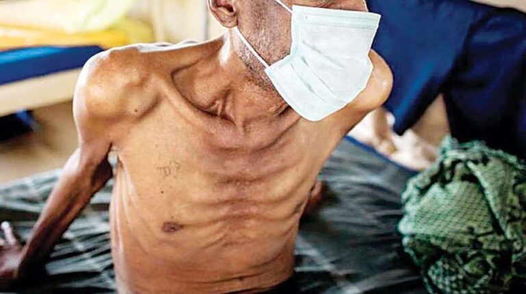 බස්නාහිර ක්ෂය රෝගීන් සියයට 45ක් – අවදානම් තැන් මෙන්න